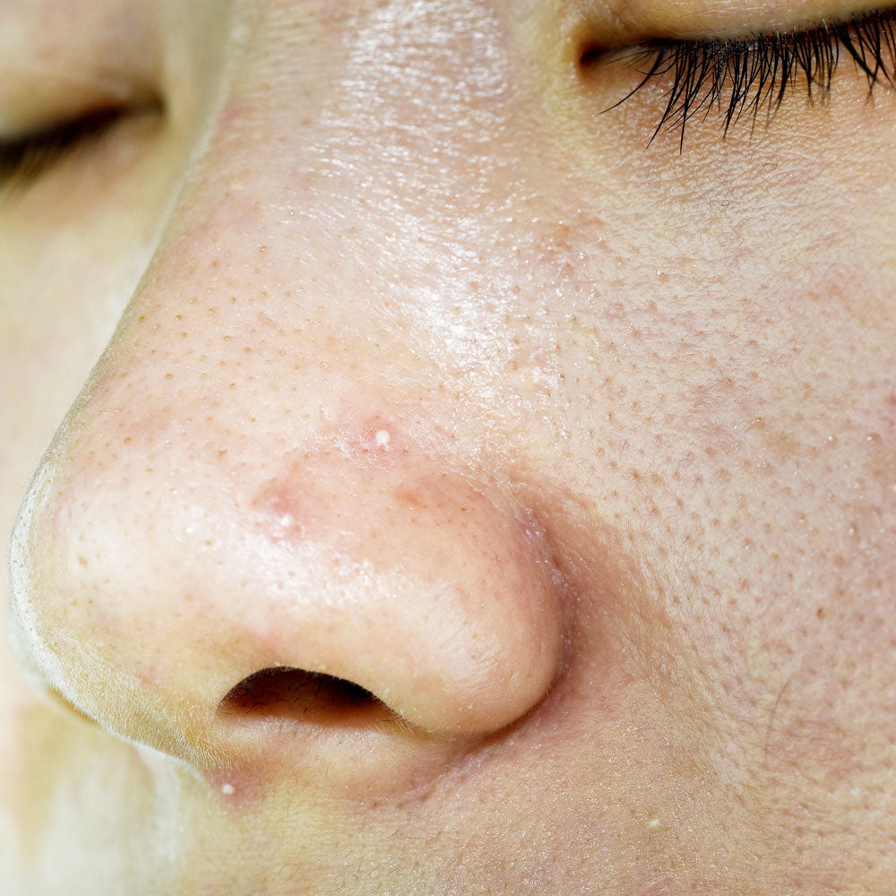 DIY Blackhead Removal | Natural Honey, Flour & Warm Water Remedy for Clear Skin | Beessential.