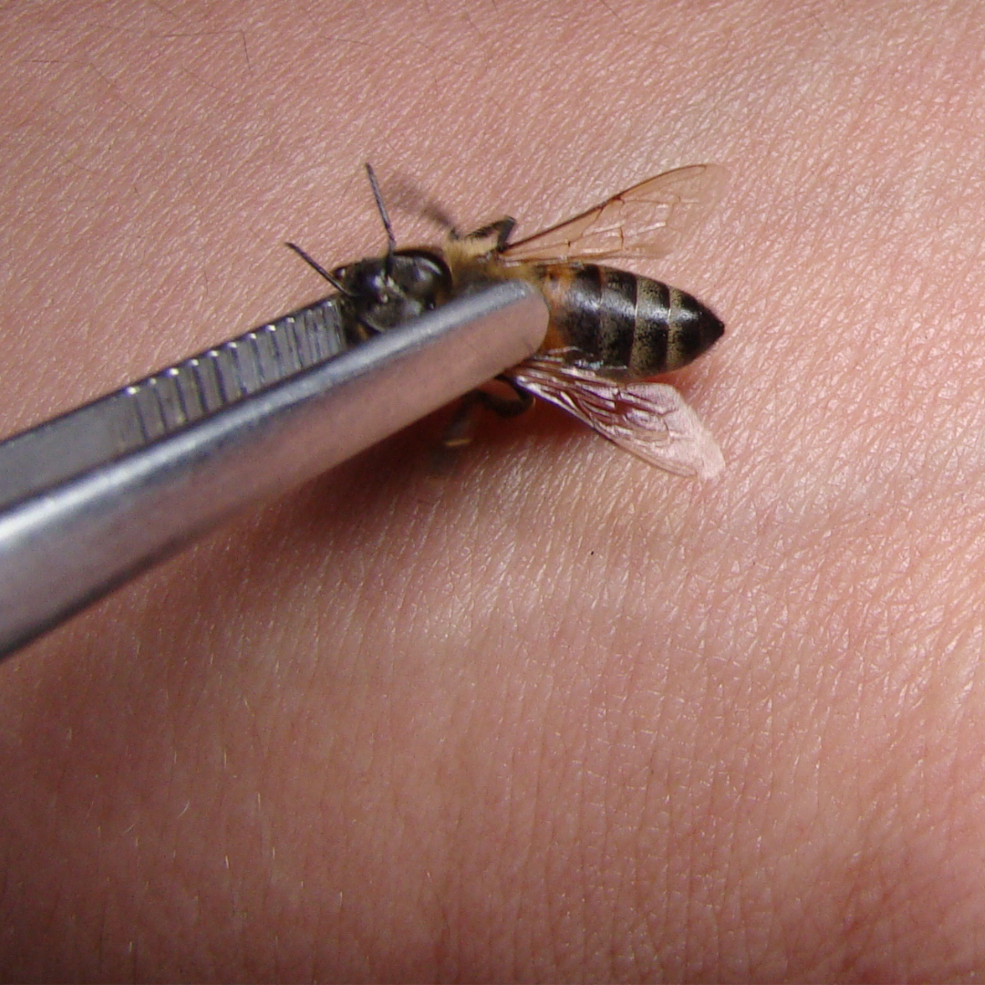 Patient receiving Bee Venom Injection