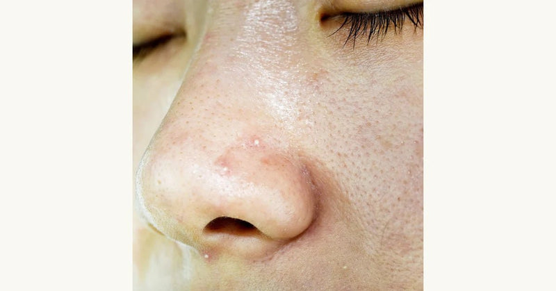 DIY Blackhead Removal: Honey, Flour, and Warm Water Solution